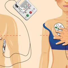 Instrukcja użycia defibrylatora: elektrody przyklejone do klatki piersiowej mężczyzny i kobiety, urządzenie gotowe do akcji.