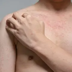 Ciało pokryte drobną, czerwoną wysypką, która może być objawem mononukleozy. Ręka drapie swędzące miejsce na ramieniu.