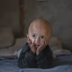 Uśmiechnięte dziecko z progerią leży na łóżku, opierając głowę na dłoniach.