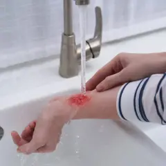 Ręka z oparzeniem 3 stopnia pod bieżącą wodą w umywalce.