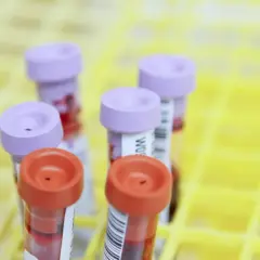 Probówki z próbkami krwi, gotowe do analizy poziomu fibrynogenu.