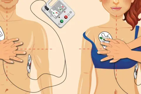 Instrukcja użycia defibrylatora: elektrody przyklejone do klatki piersiowej mężczyzny i kobiety, urządzenie gotowe do akcji.