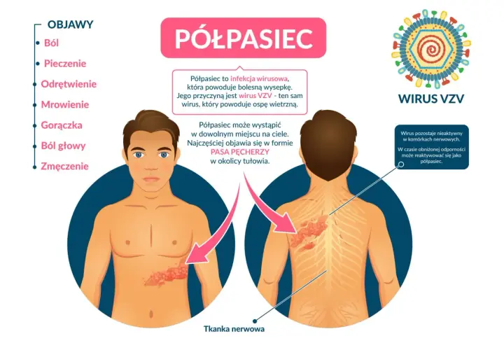 Półpasiec u dziecka objawia się bolesną wysypką, często w formie pasa pęcherzy. Wirus VZV, ten sam co od ospy, może się reaktywować.