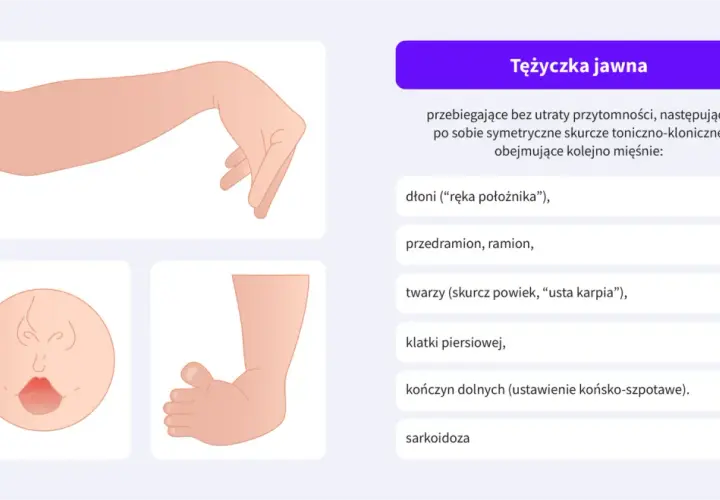 Ilustracja przedstawia objawy tężyczki: dłoń w pozycji "ręki położnika", twarz z wykrzywionymi ustami i zaciśniętymi powiekami.
