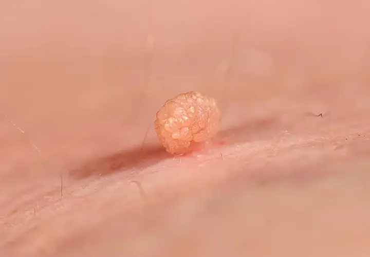 Broczawka, jeden z objawów wirusa HPV, widoczna z bliska na skórze.