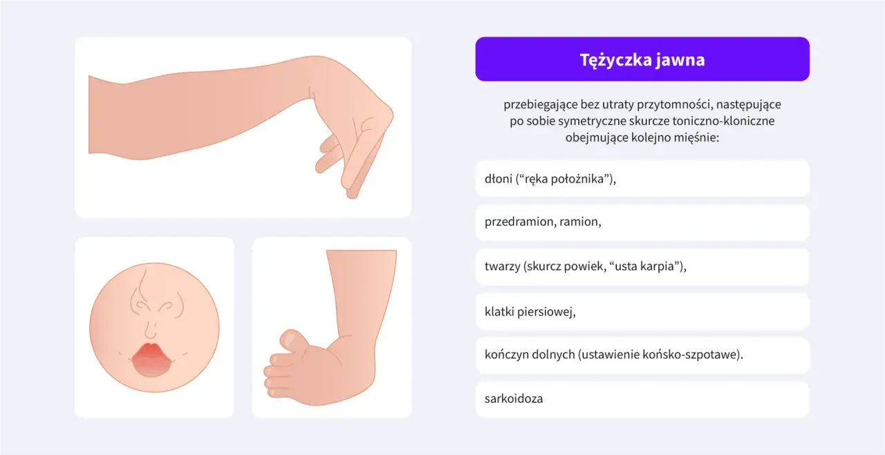 Ilustracja przedstawia objawy tężyczki: dłoń w pozycji "ręki położnika", twarz z wykrzywionymi ustami i zaciśniętymi powiekami.