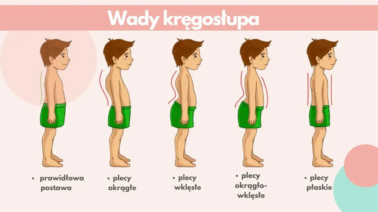 Ilustracja pokazuje wady kręgosłupa: plecy okrągłe, wklęsłe, okrągło-wklęsłe i płaskie, w tym kifoza.