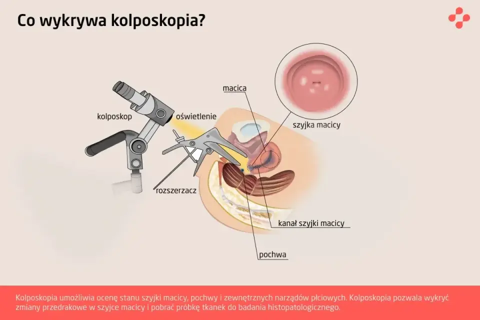 Kolposkopia bez tajemnic - jak wygląda badanie i biopsja?